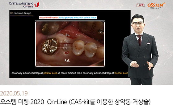 2020.05.19 오스템 미팅 2020 On-Line (CAS-kit를 이용한 상악동 거상술)
